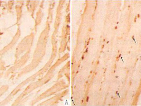 肌营养不良症受累肌肉的细胞凋亡
